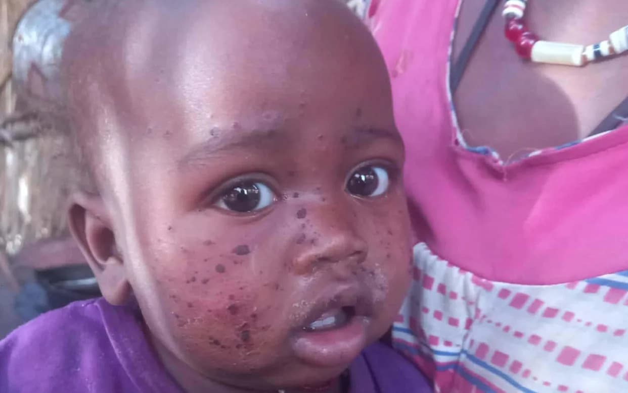 Suspected Mpox Outbreak in Darfur: 200+ Cases Reported, Aid Workers Warn of Wider Spread