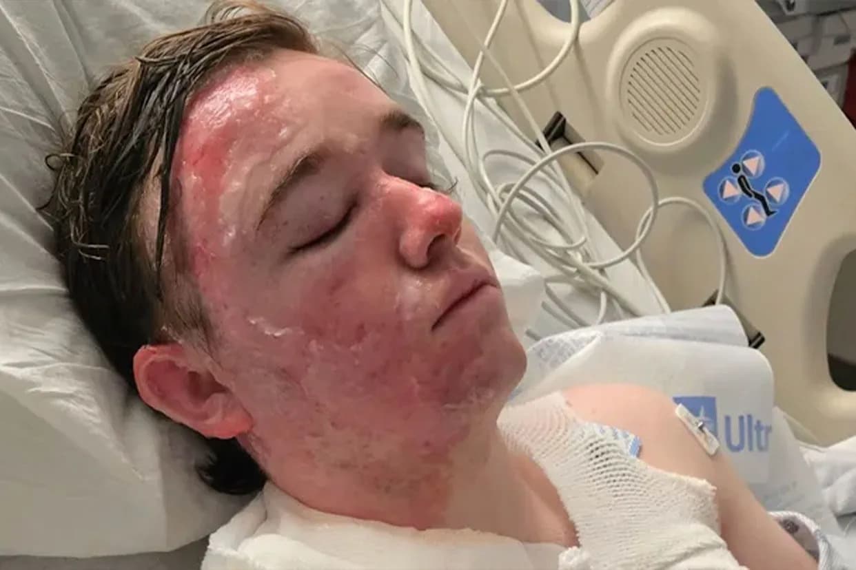 McDonald's Shift Manager Hospitalized With Second‑Degree Burns After Alleged Hot‑Oil Assault
