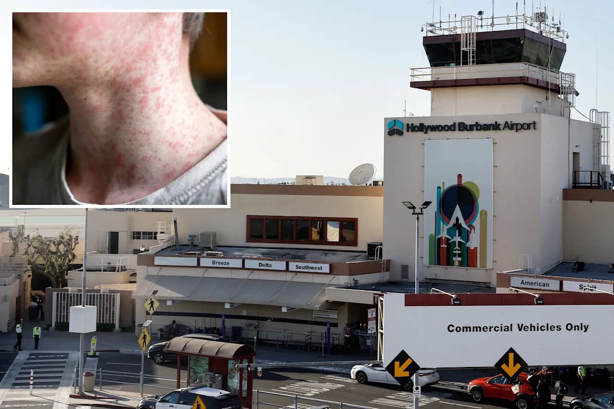 Measles Case Linked to Hollywood Burbank Airport — Potential Exposures Identified