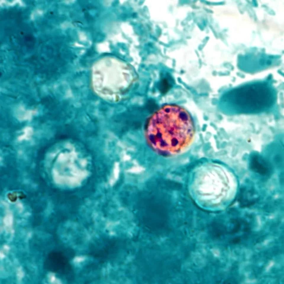 Ohio Nears 200 Cyclosporiasis Cases; Health Officials Urge Caution After Multiple Hospitalizations
