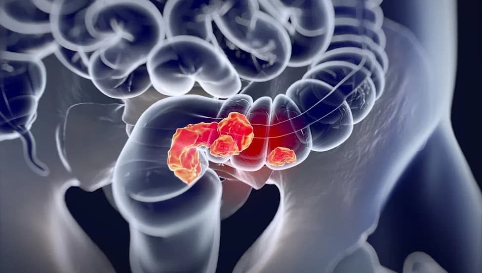 EndoQuest Completes PARADIGM Enrollment as ELS Robotic System Shows Promising Early Results