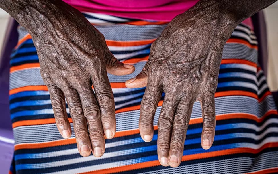 Mpox Outbreak in Madagascar Tops 3,000 Cases as High Test Positivity Suggests Wider Spread