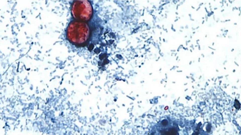 CDC: Over 18,000 Cyclosporiasis Cases Reported Across 45 States — Investigation Links Many to Recalled Lettuce