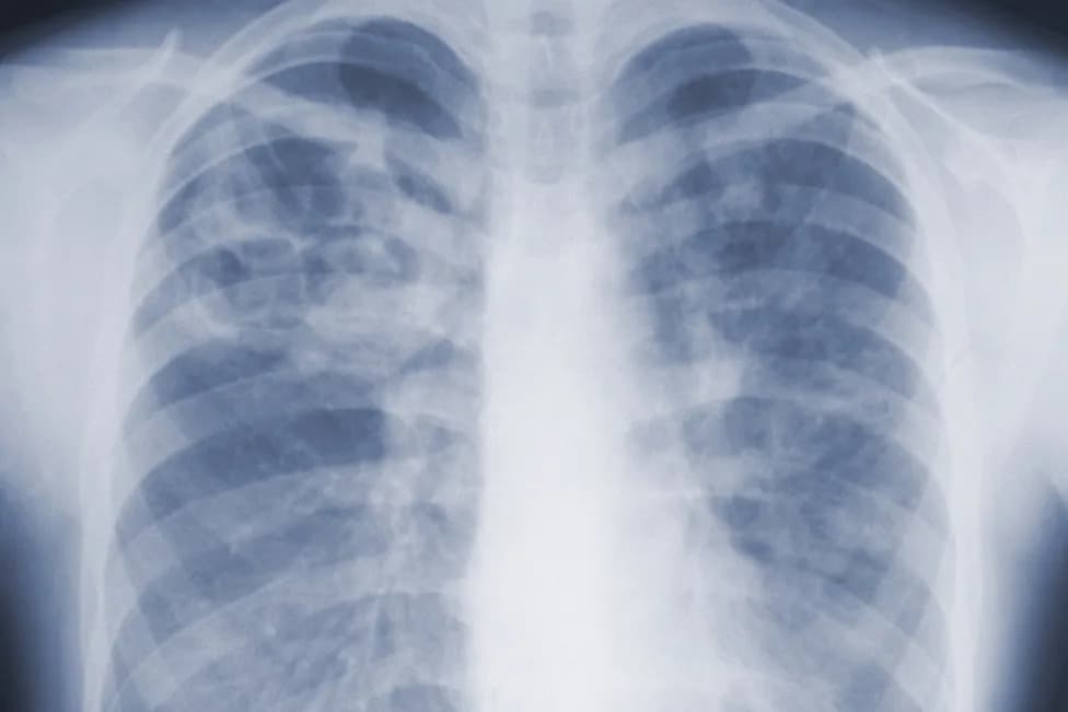 CDC Study: Invasive Mold Infections in Atlanta Hospitals Highlight Underrecognized, Potentially Deadly Risk