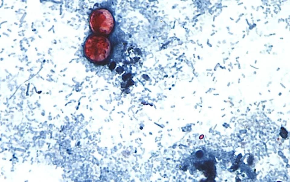 Cyclospora Alert For UK Travellers To Mexico — 67 Returnees Reported; Avoid Uncooked Fruit And Salad