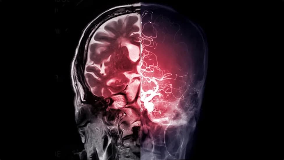 Metformin’s Surprise Target: Study Finds Common Diabetes Drug Also Acts in the Brain