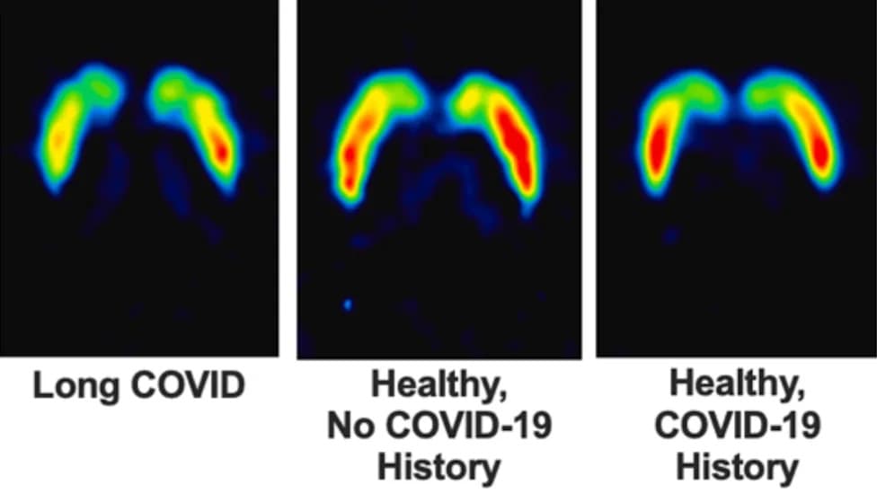 PET Scans Show About 18% Fewer Dopamine Nerve Endings in People With Long COVID