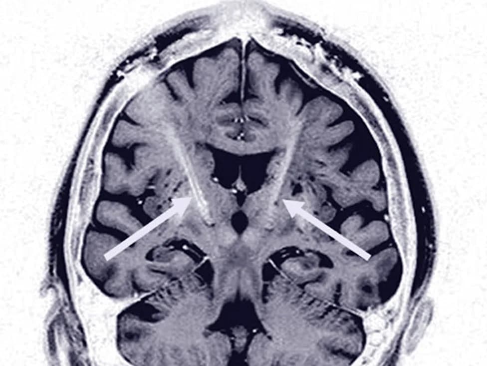 New Genetic Clues Link Dopamine Disruption to Early Parkinson’s — Northwestern Study Points to Therapy Targets