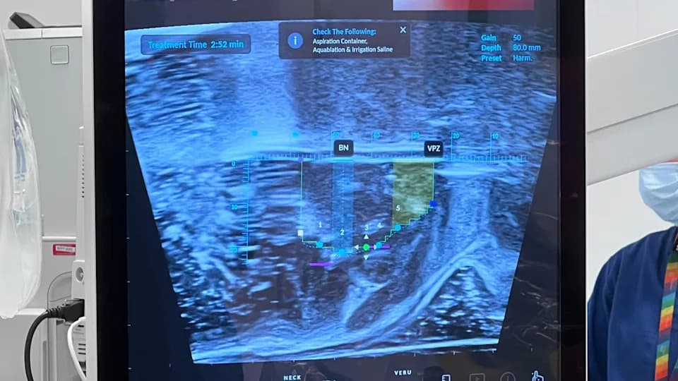 AI-Guided Robotic Water-Jet Surgery Helps Men With Enlarged Prostates Reclaim Their Lives