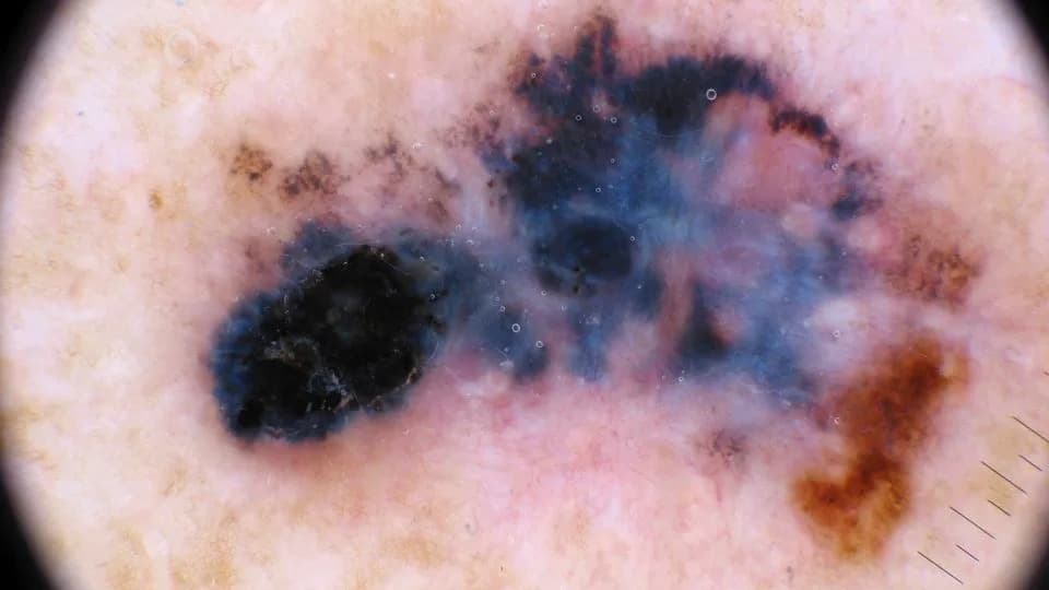 Moderna and Merck Report Major Win: Personalized mRNA Vaccine With Keytruda Cuts Melanoma Recurrence
