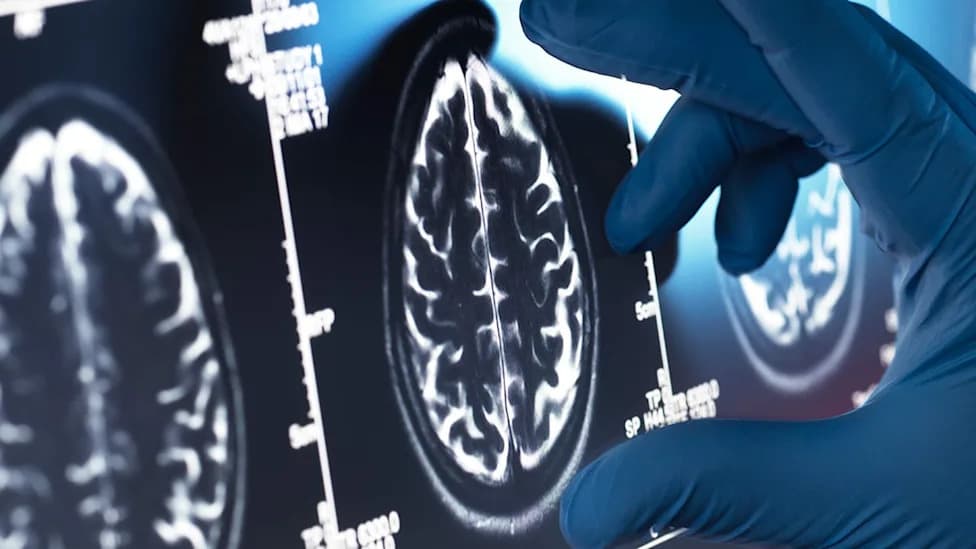 Brain Scans Reveal Shared Network Disruption in Schizophrenia and Bipolar I — Schizophrenia Shows Broader Changes