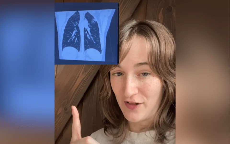 Persistent 'Allergy' Cough Turned Out To Be Valley Fever After X‑Ray Revealed Truth
