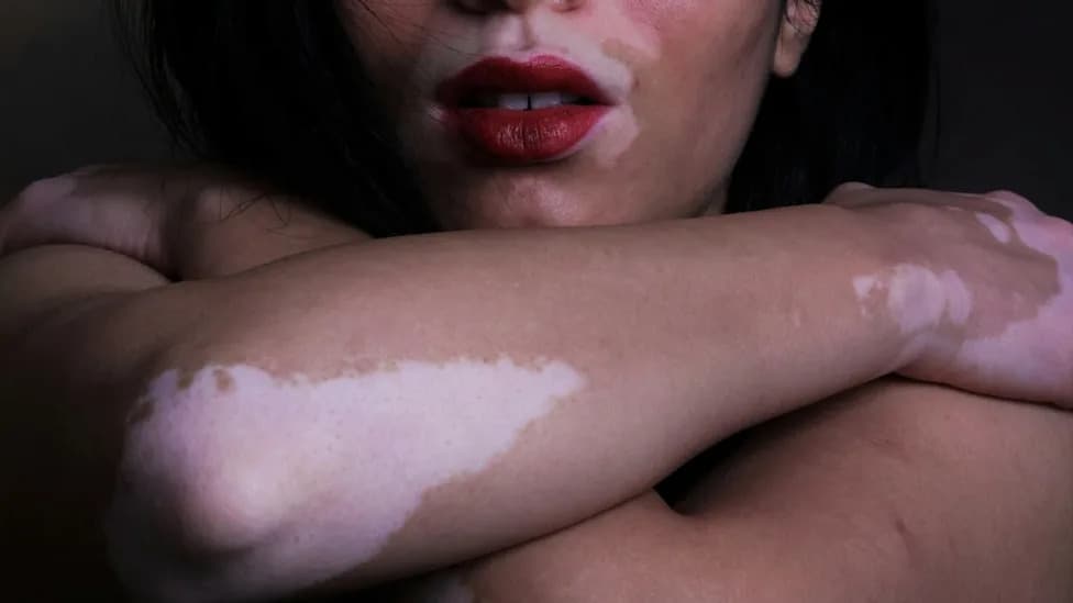 Once‑Daily Pill Restores Skin Color in Some People With Vitiligo, Large Trials Show