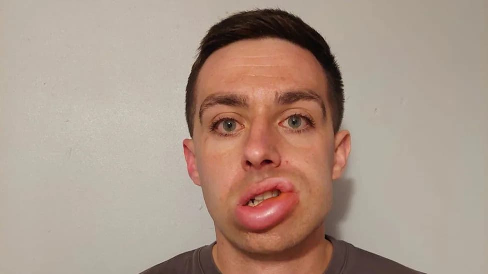 Trial Treatment Stops Weekly Swelling — "It's Changed My Life," Says 30-Year-Old Joiner