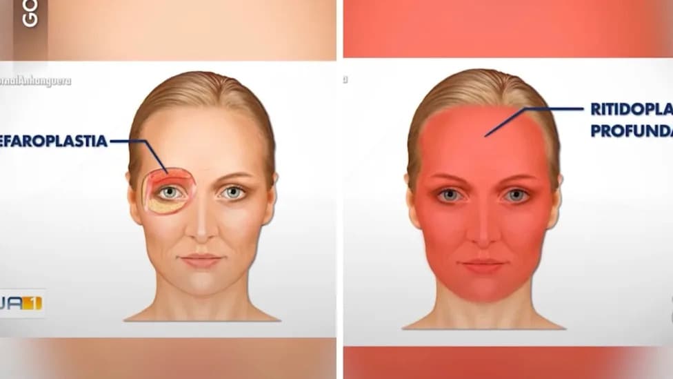 Six Procedures in Eight Hours: Brazilian Businesswoman’s Death Fuels Debate Over Cosmetic Surgery Safety