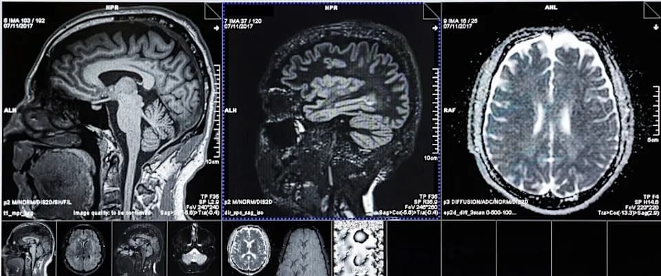 Depression May Signal Early Alzheimer’s Changes — Tau Protein Linked To Mood Shifts Years Before Memory Loss