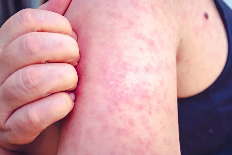 Measles Surge in Maryland: 31 Cases Confirmed; Outbreaks Declared in Three Counties