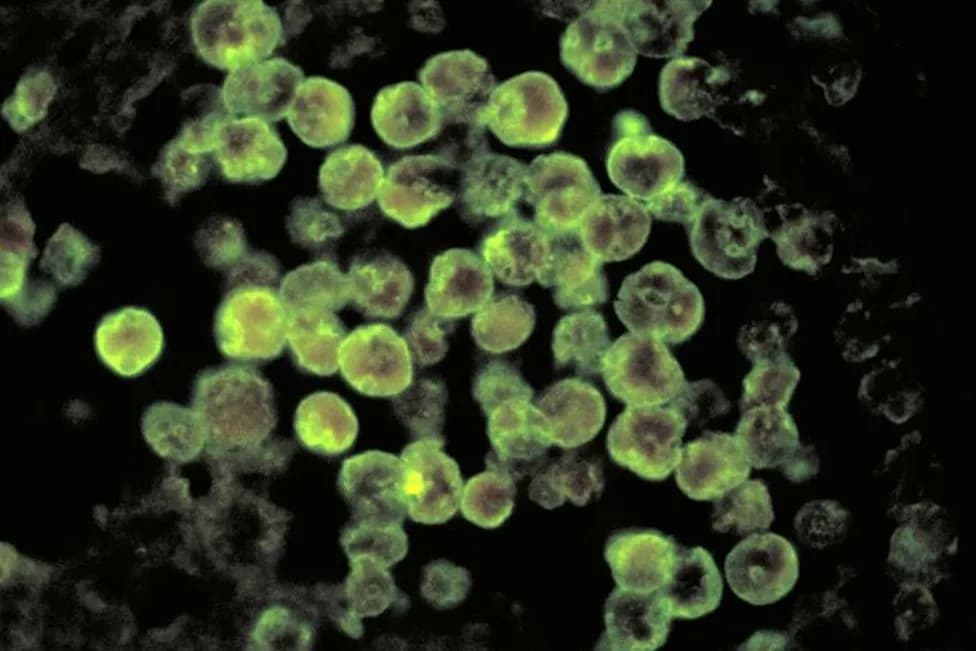 North Carolina Teen Critically Ill After Rare 'Brain‑Eating' Amoeba Infection