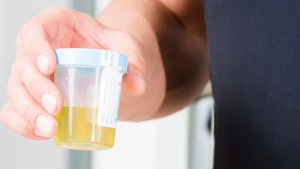 At-Home Urine Test Identifies 92% Of Bladder Cancers in NHS Trial — Could Cut Need For Invasive Cystoscopies