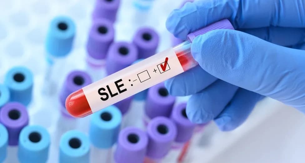 Alumis Advances Envudeucitinib to Phase III in Lupus Despite Phase IIb Miss; Strong Signal in High‑Interferon Subgroup