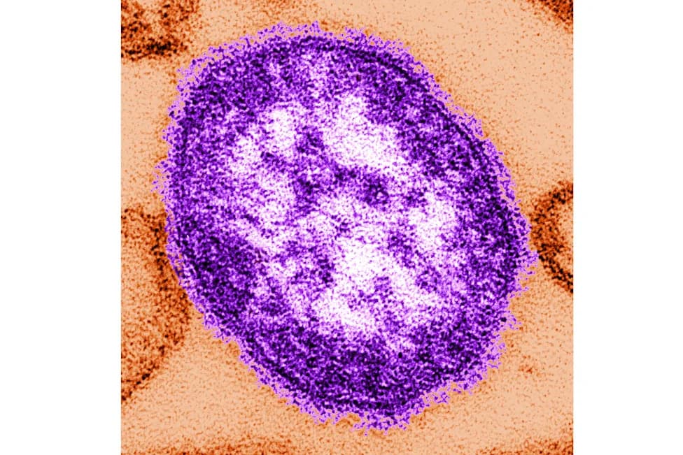 Coroner Confirms Measles Killed One Infant; Two Measles-Linked Deaths Reported in Pennsylvania Outbreak