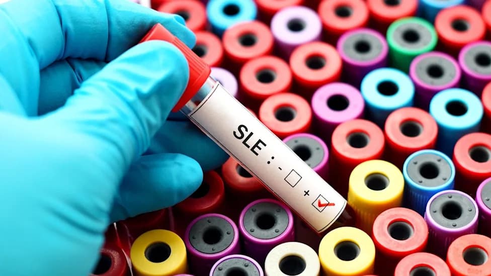 Beeline’s Afimetoran Hits Primary Endpoint in Global Phase II SLE Trial