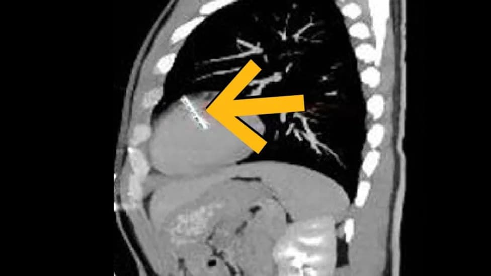 36-mm Sewing Needle Removed From Man’s Left Ventricle After He Sought Care For Blood In Urine