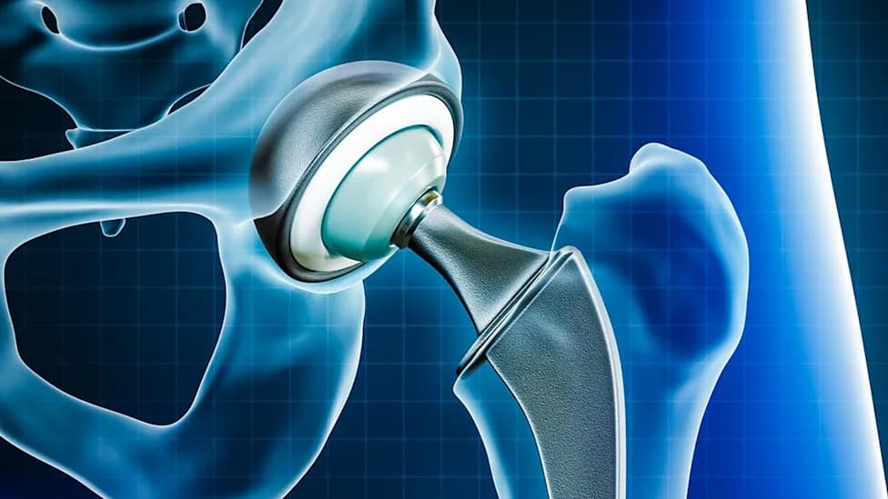 Metal Debris From Joint Replacements Detected in Human Brains — Cobalt Linked to Alzheimer’s Protein Build-Up