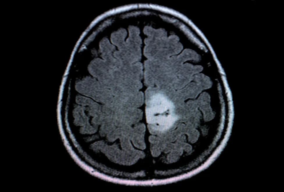 AI May Spare Some Brain Tumour Patients From MRI Contrast Dye — Study