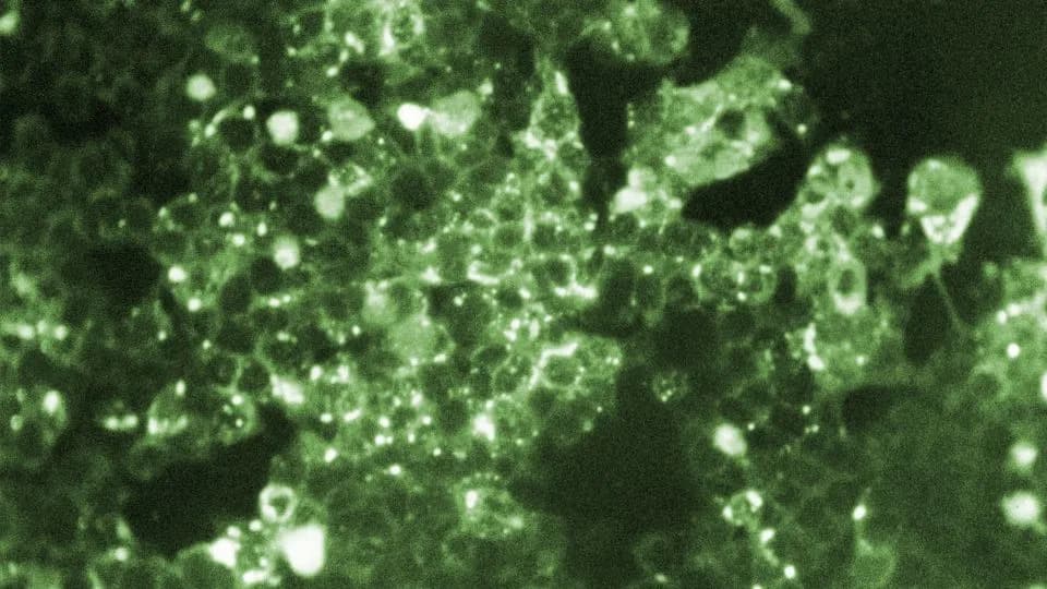 Measles Deaths Rise in Pennsylvania as U.S. Vaccination Rates Fall — What You Need to Know