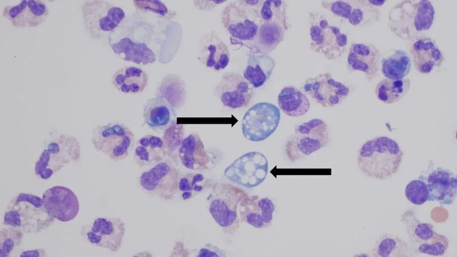 CDC: Durham Water Feature Likely Source Of Teen’s Fatal 'Brain‑Eating' Amoeba Infection