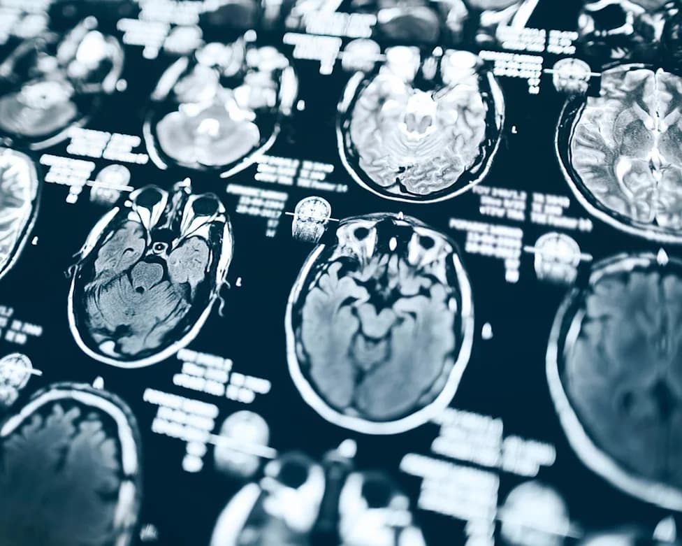 NIH Grant Cut Leaves 600 Pittsburgh Participants Without Promised Alzheimer’s Test Results