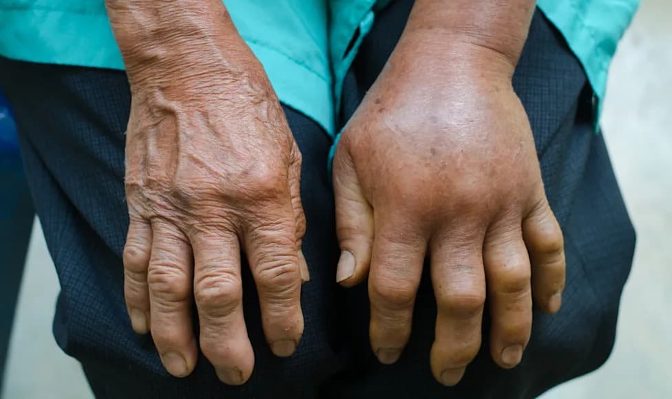 New Review Finds Snakebite Deaths Likely Undercounted in Poor, Rural Regions