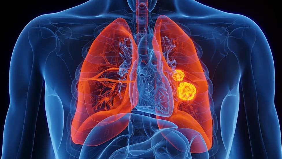 Rare Inherited EGFR Variant Dramatically Raises Lung Cancer Risk in Nonsmokers, Study Finds