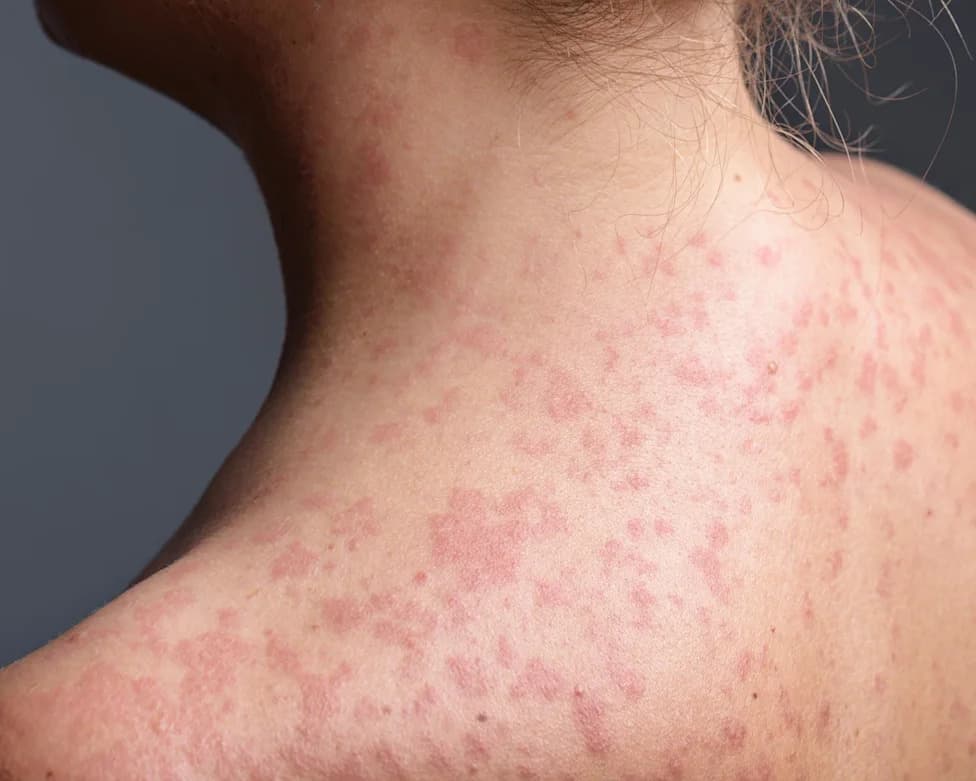 California Issues Measles Exposure Alert After Unvaccinated Passenger Traveled Through Six Counties on Amtrak