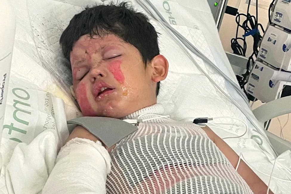 7-Year-Old Severely Burned After Home 'Science Experiment' Ignites Shirt — Family Rallies to Help