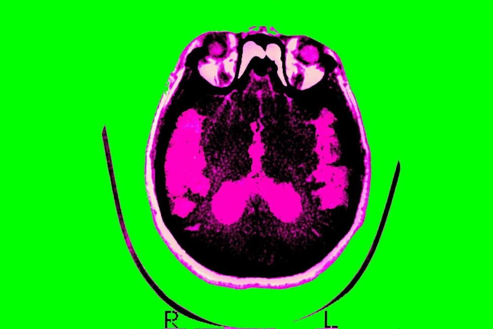 New Hope for Alzheimer’s: Two FDA-Approved Drugs, GLP‑1 Research, and a Controversial Surgical Claim