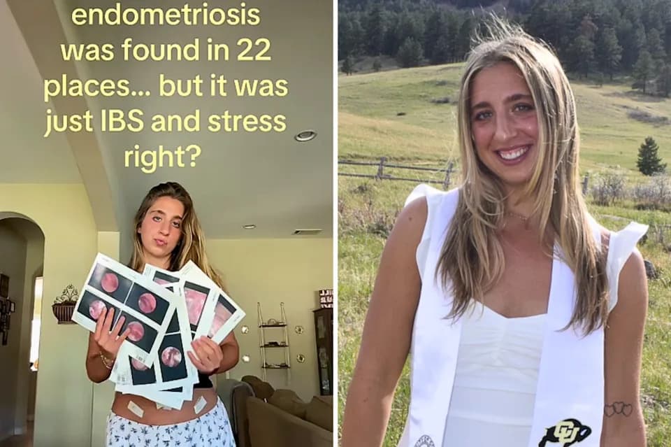 Told It Was IBS And Stress For Years — 23-Year-Old Finally Diagnosed With Stage 2 Endometriosis