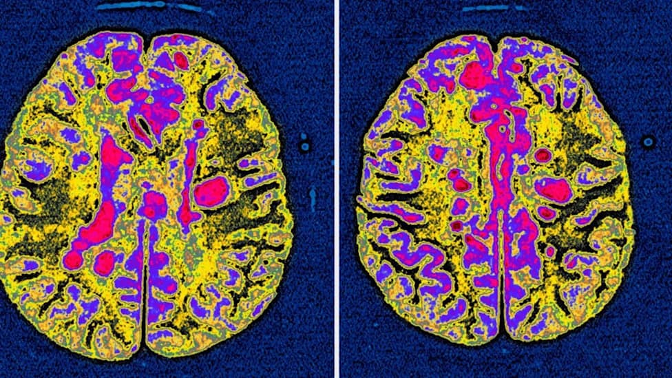Modified HIV Drug Reverses Vision Loss and Paralysis in MS-Like Mice, NIH Study Finds