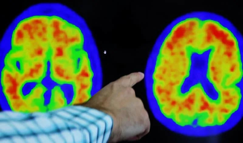 Genetic Clue Offers Hope: APOE4‑Driven Brain Vessel Damage May Be Reversed