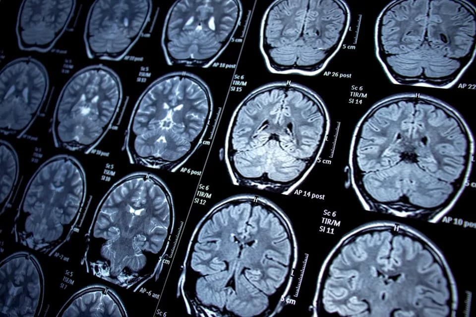 Blocking PD-L1 in Mouse Brains Restores Microglial Function and Lowers Neuronal Hyperactivity in Alzheimer’s Model