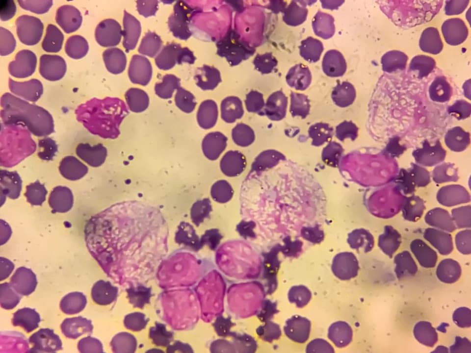 One in Eight New Cancer Cases in 2024 Linked to Infections, IARC Analysis Finds