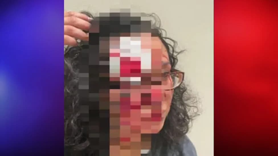 Seattle Woman Charged With Biting Stranger’s Forehead Ordered To Undergo Competency Evaluation