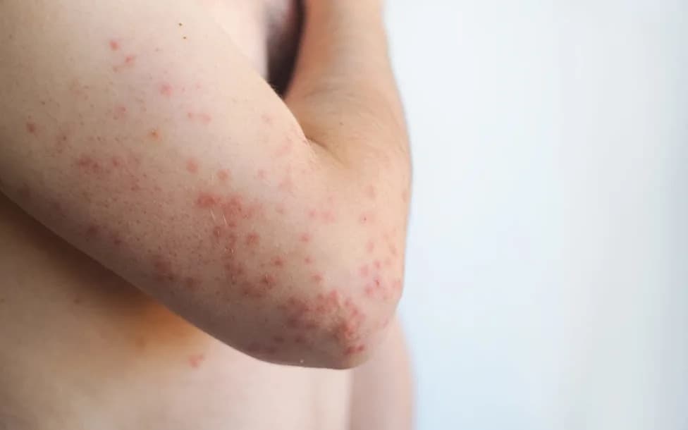 Fifth Measles-Associated Death Reported in Pennsylvania as Outbreak Surpasses 900 Cases