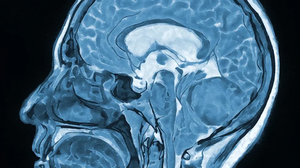 Brain Scans Suggest Dopamine Neuron Damage May Underlie Some Long COVID Symptoms